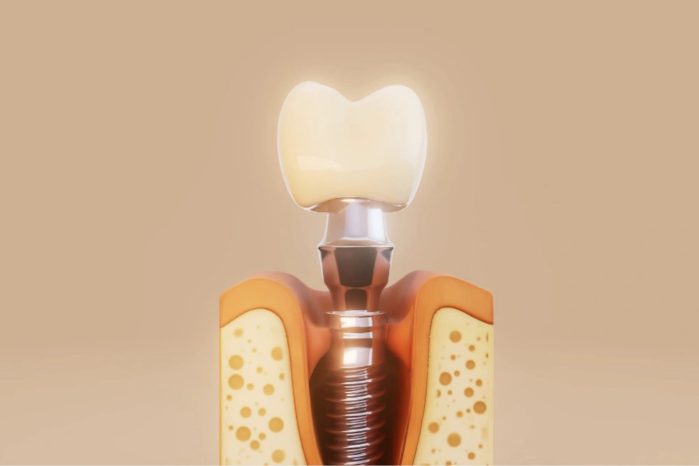 Understanding Dental Implants: A Modern Solution for Missing Teeth